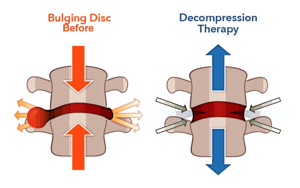 Spinal Decompression: A Gentle Approach to Relieving Pressure and Restoring Comfort
